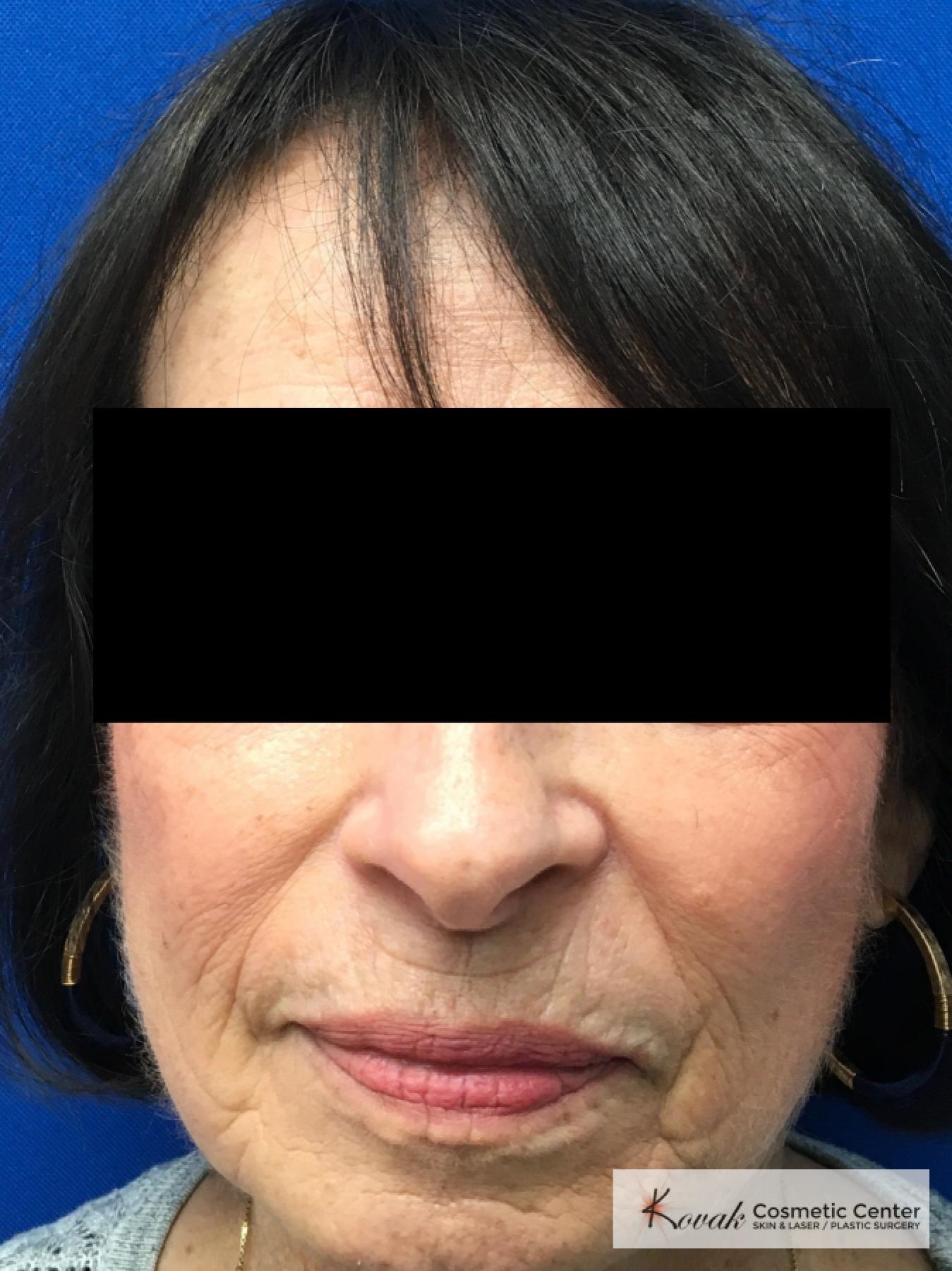 Sculptra for facial volume on a 71 year old female - After  