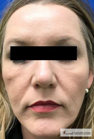 BOTOX® Cosmetic: Patient 6 - After  