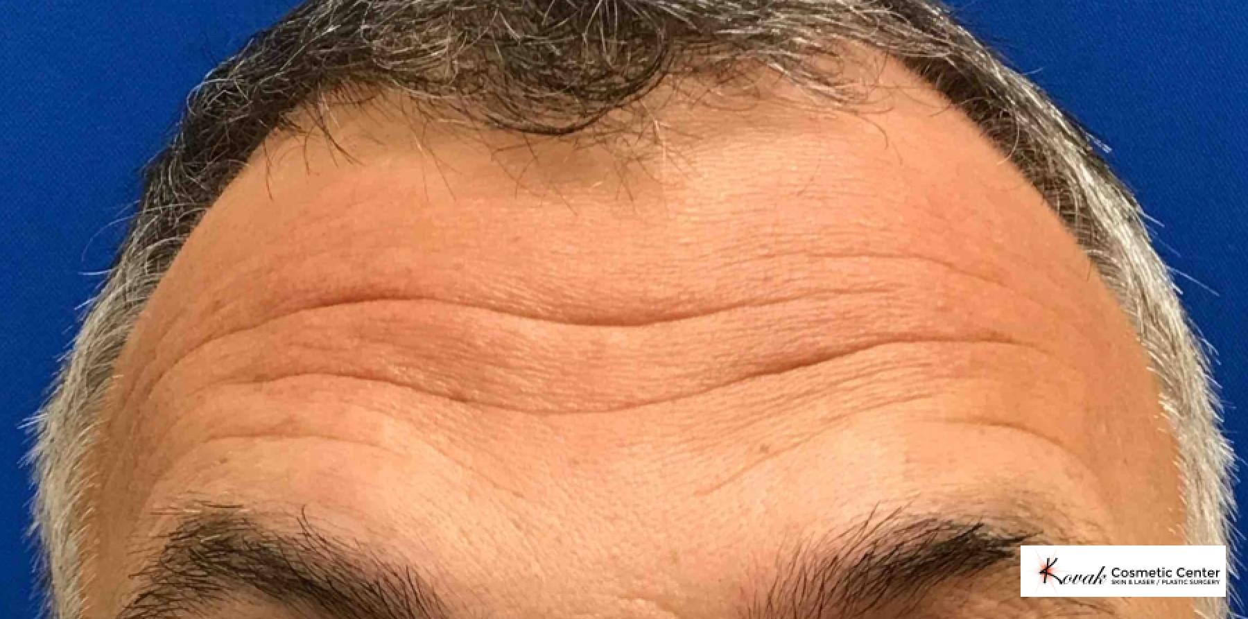 Volbella for Forehead Lines on a 52 year old male - After  