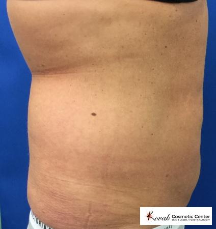 CoolSculpting®: Patient 1 - After 2
