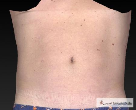 CoolSculpting®: Patient 19 - After 1