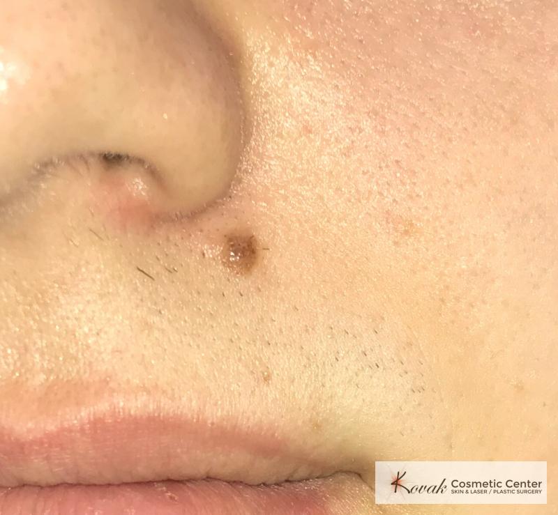 Mole Removal on a 25 Year old Male - Before 