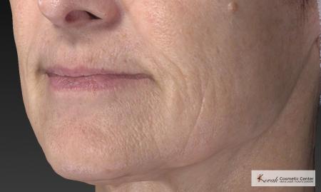 Injectables - Mouth: Patient 8 - After Image 4