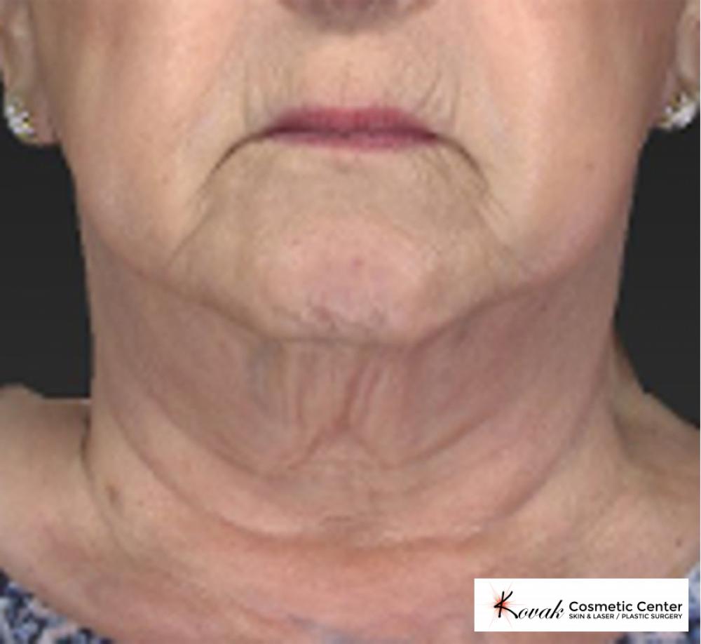 CoolSculpting®: Patient 5 - Before 