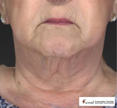 CoolSculpting®: Patient 5 - Before 1
