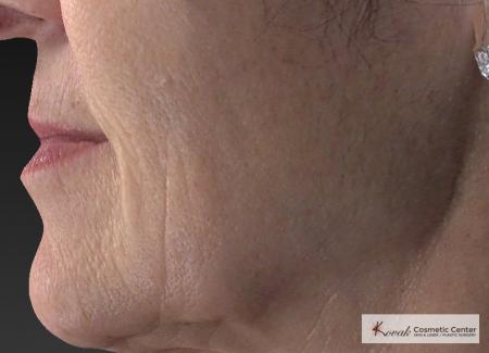 Injectables - Mouth: Patient 8 - Before Image 3