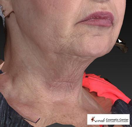 Kybella: Patient 2 - Before Image 2