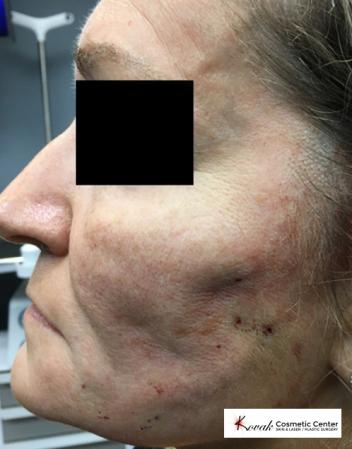 Silhouette Lift™: Patient 2 - Before Image 1