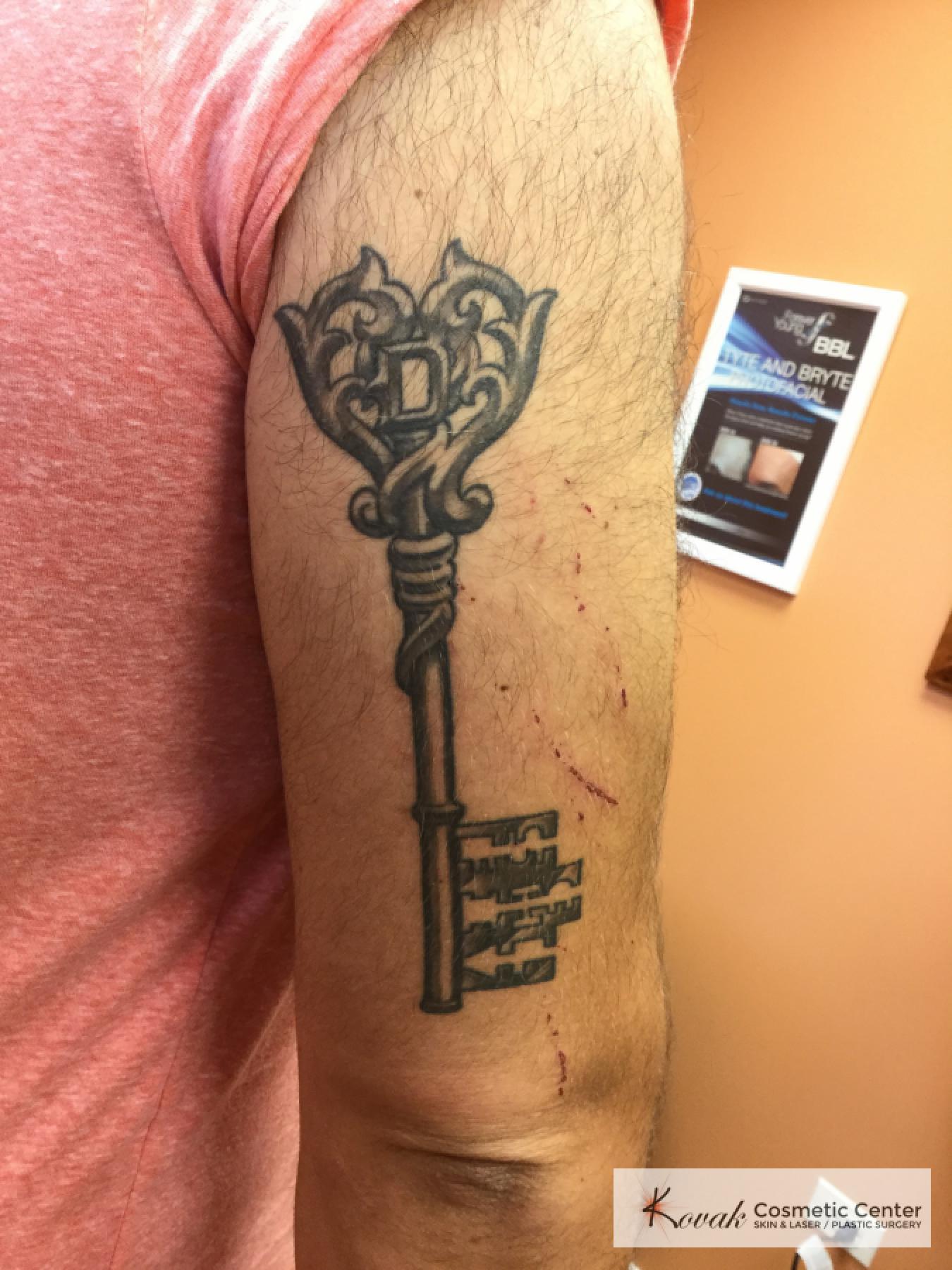 Tattoo Removal: Patient 4 - Before 