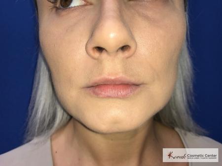 Restylane® Silk: Patient 12 - Before 1
