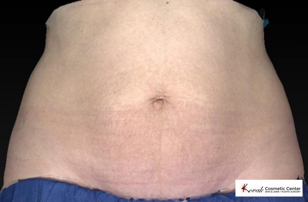 CoolSculpting Patient 101 - After  