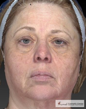 Tyte And Bryte – Face: Patient 3 - Before Image 4