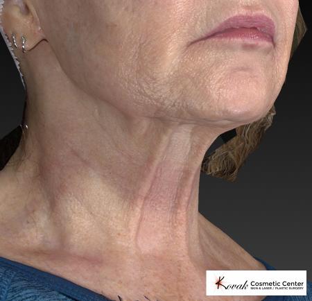 Kybella: Patient 2 - After Image 2