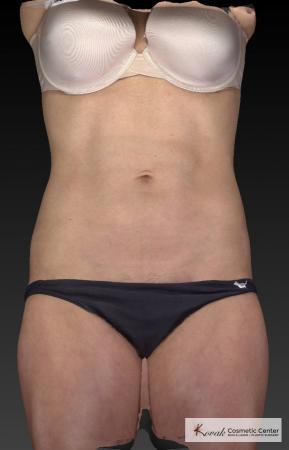 CoolSculpting®: Patient 22 - After