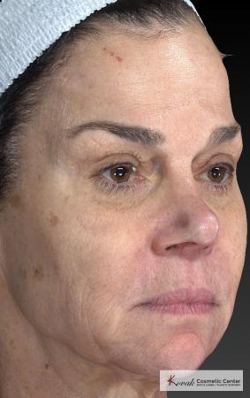 Halo™: Patient 3 - Before and After 5