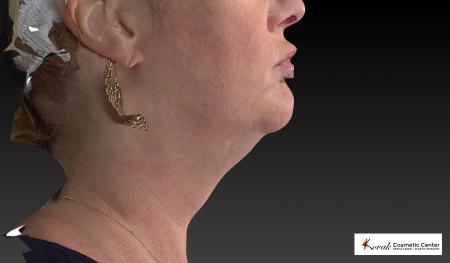 Kybella: Patient 1 - After Image 5
