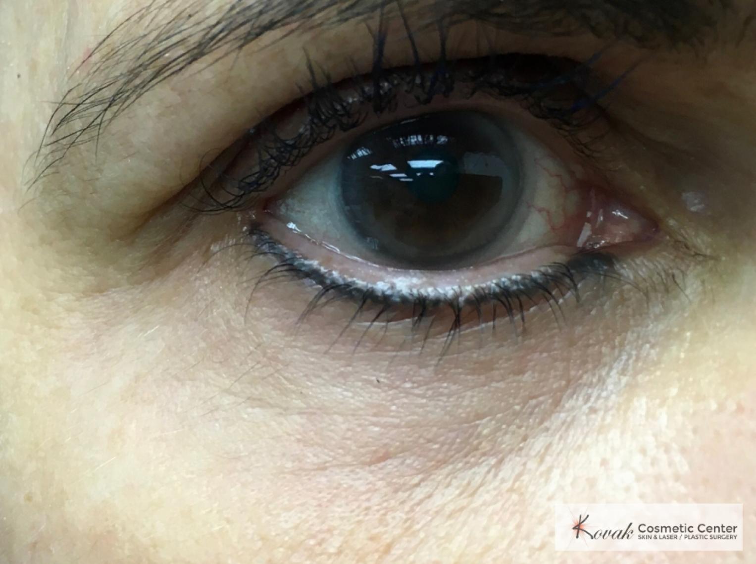 Under Eye Wrinkle Treatment with Agnes - After 1