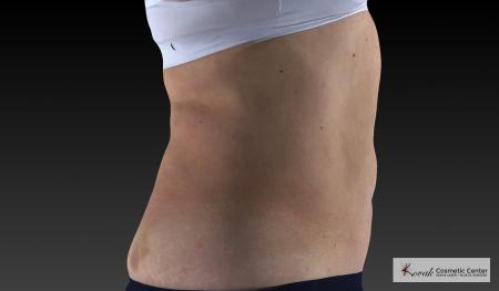 CoolSculpting®: Patient 18 - After 4