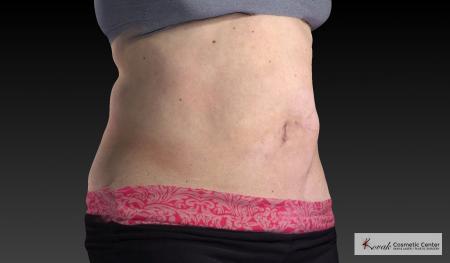 CoolSculpting®: Patient 18 - Before 2
