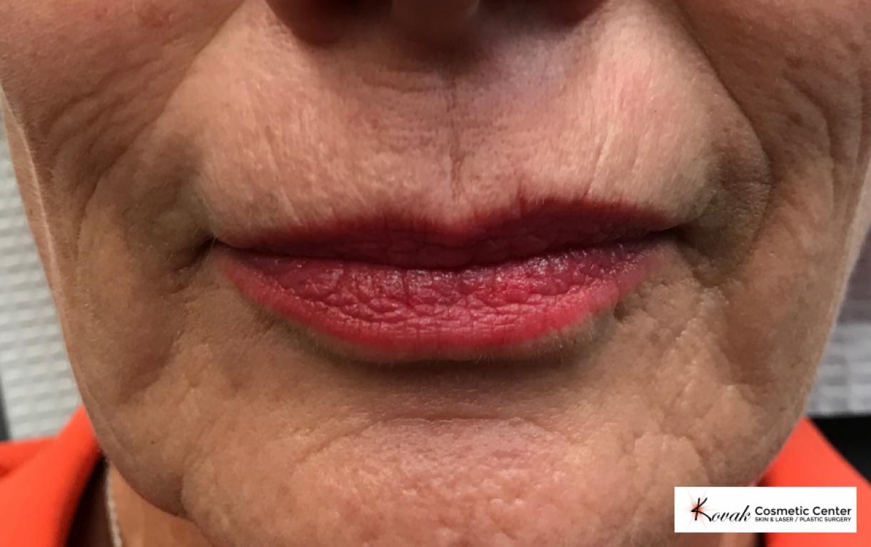 Juvéderm® XC: Patient 4 - Before 