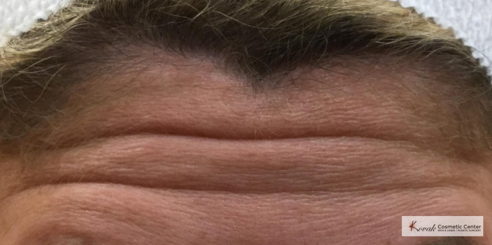 Restylane Silk for Forehead Lines on a 40 year old woman - Before 