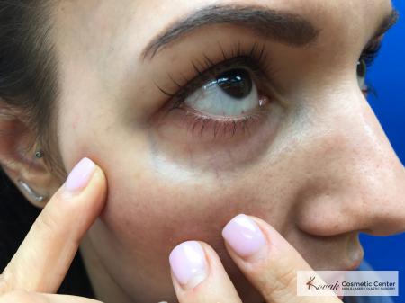 Eye Vein Treatment: Patient 3 - After Image 1
