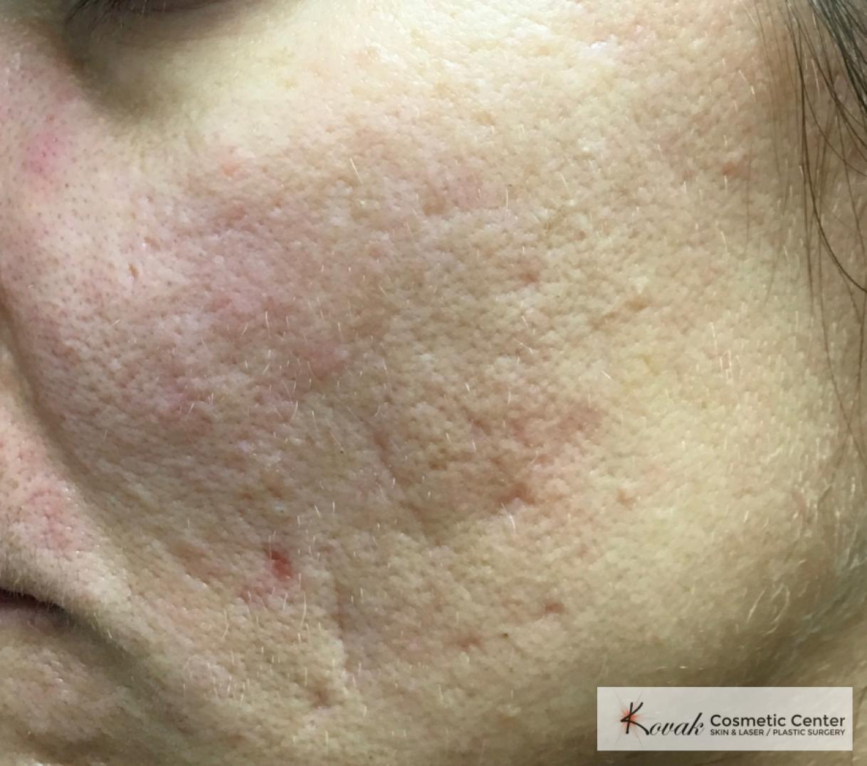 Acne Scars treated with Venus Viva on 35 year old woman - Before 