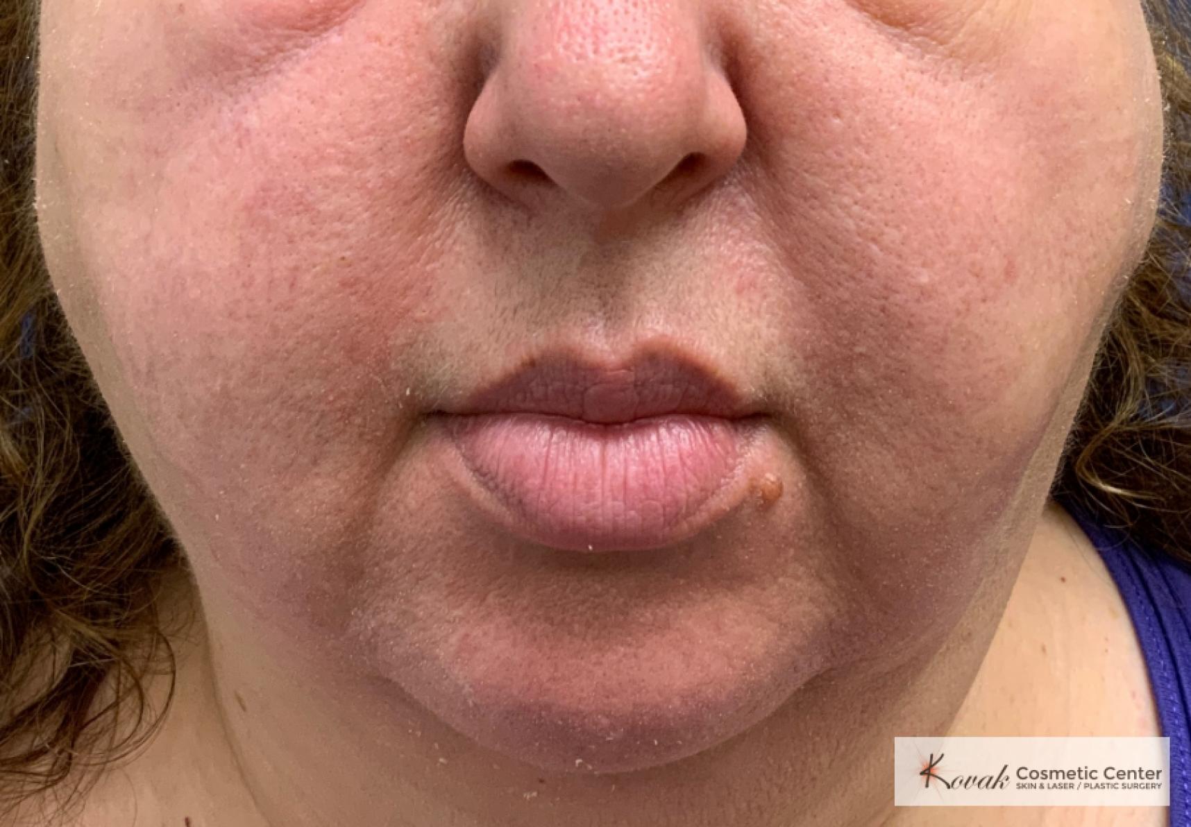 Laser Liposuction using the Vaser system of the jawline on a 52 year old female - After  