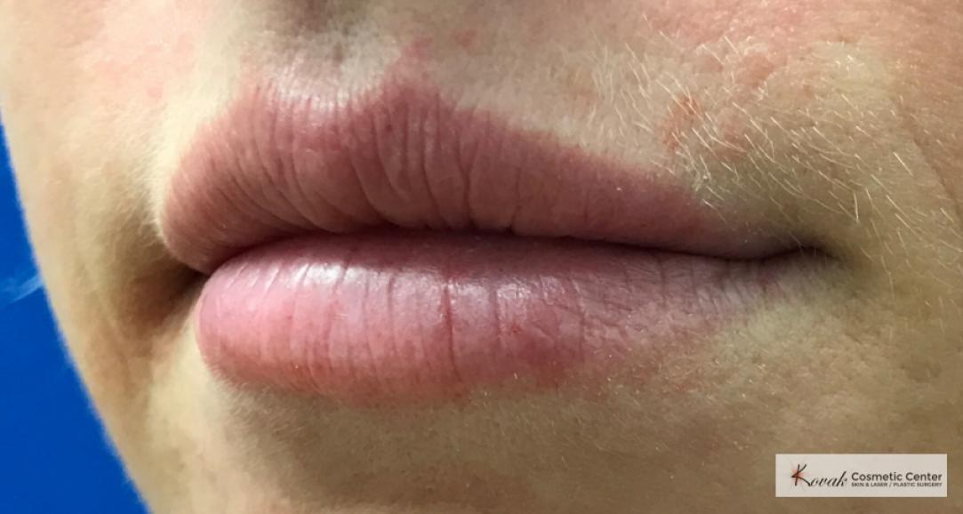 Restylane®: Patient 2 - After  