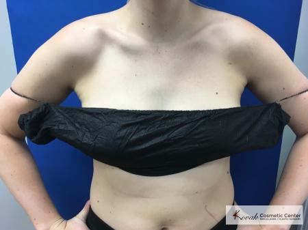 Laser Liposuction: Patient 4 - After 2