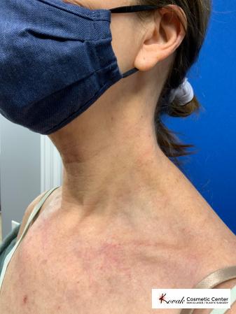 Microneedling on the neck of a 61 year old female using Scarlet - After 2