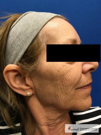 Full Face Laser Skin Resurfacing on a 70 year old woman - Before and After Image 3