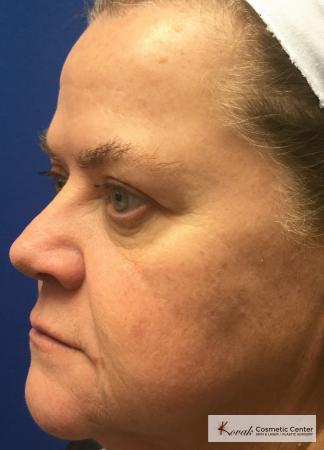 Restylane® Silk: Patient 13 - After 2