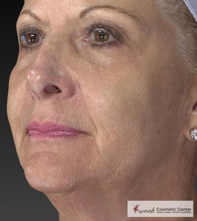 Injectables - Face: Patient 1 - After 2