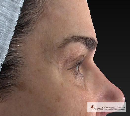 Laser Skin Resurfacing - Face: Patient 2 - After  