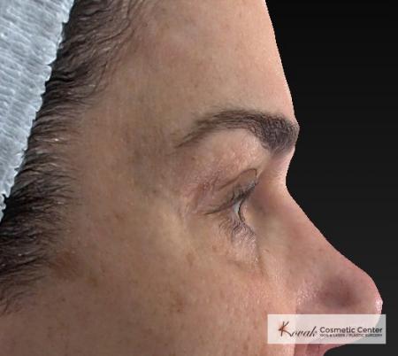 Laser Skin Resurfacing - Face: Patient 2 - After 1