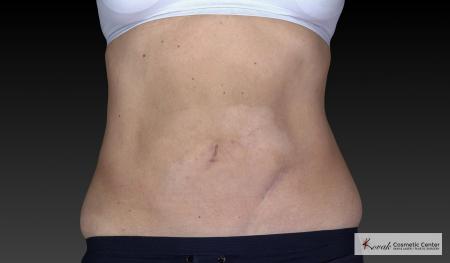 CoolSculpting®: Patient 18 - After