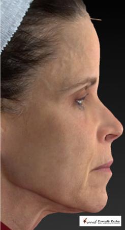 Silhouette Lift™: Patient 1 - Before Image 1