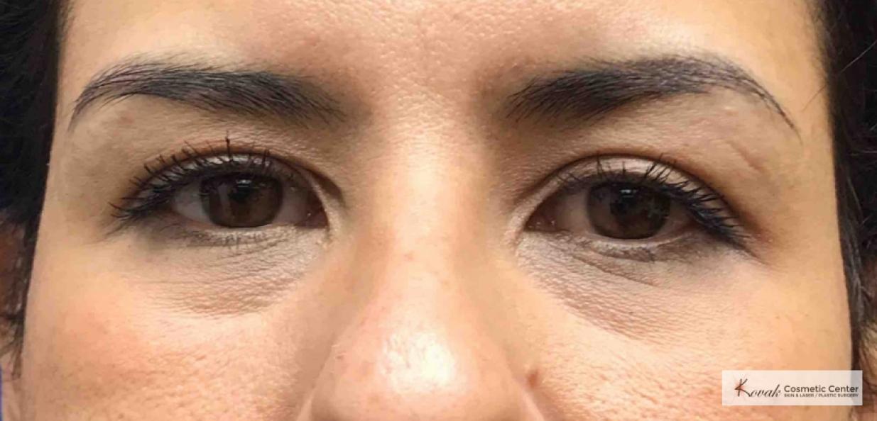 Injectables - Face: Patient 4 - Before 