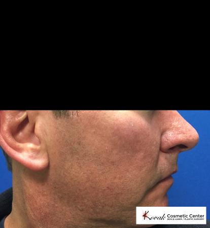 Juvéderm® XC: Patient 1 - After 3