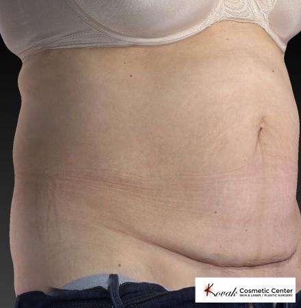 CoolSculpting®: Patient 8 - After 2