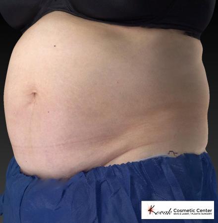 CoolSculpting®: Patient 8 - Before and After 5
