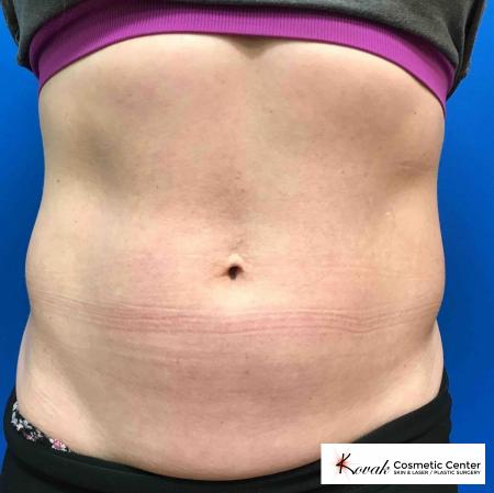 CoolSculpting®: Patient 2 - Before 