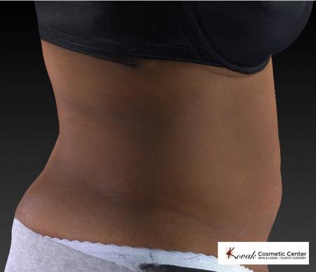 CoolSculpting®: Patient 15 - Before 3