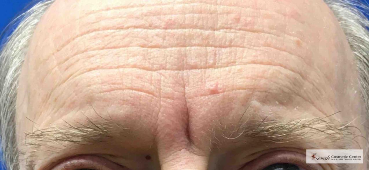 Juvéderm® XC: Patient 10 - Before 