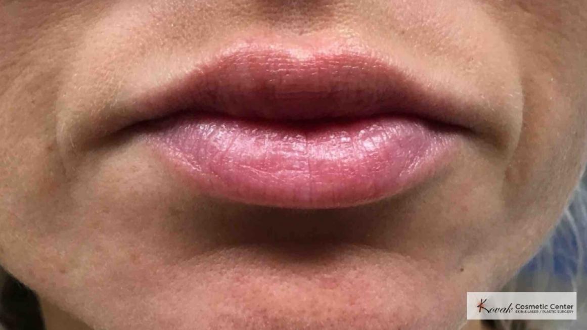 Lip Augmentation: Patient 3 - After  