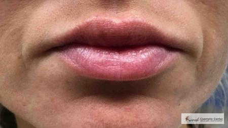 Lip Augmentation: Patient 3 - After 1