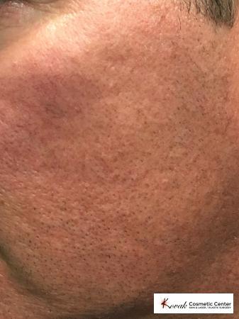 Acne Scars treated with Juvederm on 45 year old male - After Image 2