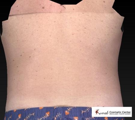 CoolSculpting®: Patient 19 - After 3