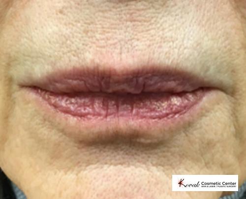 Restylane® Silk: Patient 8 - After  
